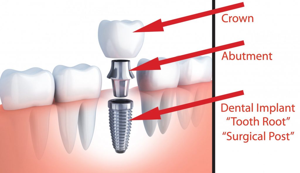 Dental Implants Cornwall Newquay Dentist Atlantic Dental