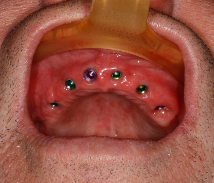 Dental Implants multiple teeth Dental World