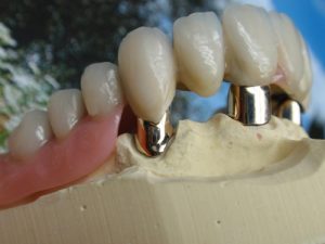 Telescopic Dentures at Atlantic Dental