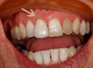 Gum recession and root infection