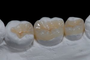 Emax Crowns at Atlantic Dental
