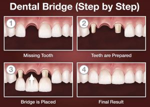 Dental Bridge Work at Atlantic Dental