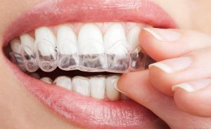 Teeth Whitening at Atlantic Dental