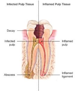 Tooth decay and abscess